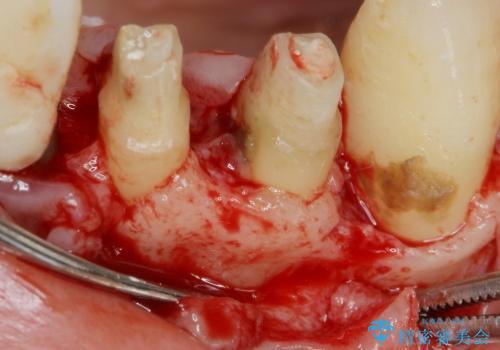 [ 前歯の歯周病治療① ]  再生治療・歯周ポケット除去