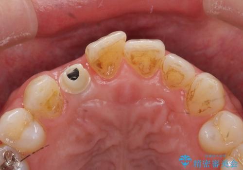 [ 骨造成を伴う前歯審美インプラント② ] ジルコニアカスタムアバットメント・クラウンの作製の治療中