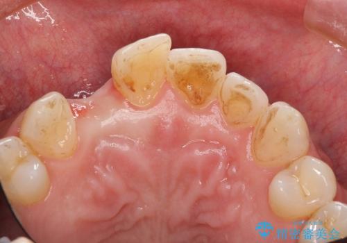 [ 骨造成を伴う前歯審美インプラント① ] インプラント埋入→2次手術の治療前