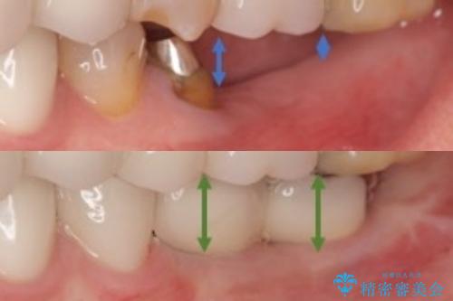 インプラントによる奥歯の咬合機能回復　クラウン高径のない場合骨外科による対応