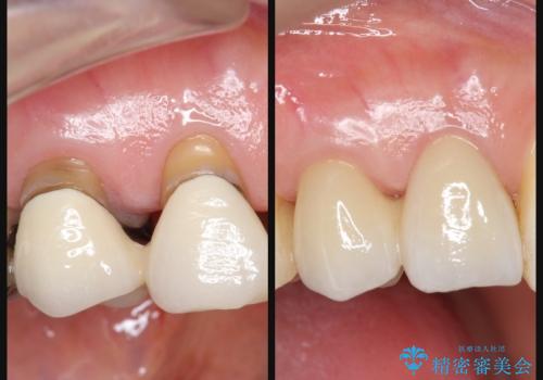 [歯の金属色を改善]　前歯の審美セラミック治療