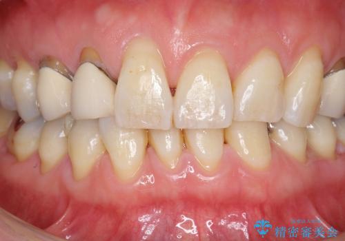 [歯の金属色を改善]　前歯の審美セラミック治療の治療前