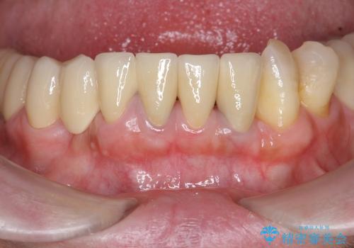 [ 前歯の歯周病治療② ]  再生治療後の歯ぐきの治癒・セラミッククラウンの作製の治療後