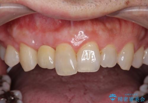 [ 骨造成を伴う前歯審美インプラント② ] ジルコニアカスタムアバットメント・クラウンの作製の治療後