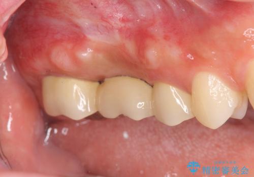 歯周外科手術を併用し清掃性を高めたブリッジ治療の治療前