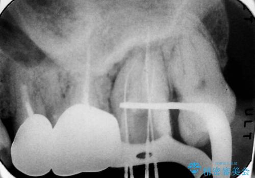 膿の出口(瘻孔)と患歯の位置にずれがあったケース:左上7番の再根管治療の治療中