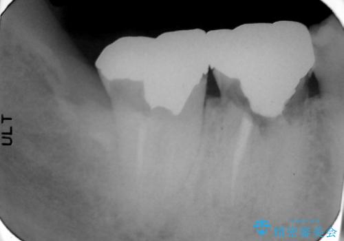 石灰化による根管の閉塞を伴う根尖性歯周炎 : 右下7番の再根管治療(リトリートメント)ケースの治療前