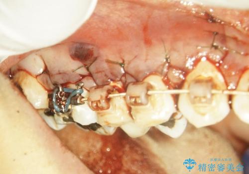 右上5番の歯髄壊死に伴う大きな根尖病変に対する治療その②:矯正治療中の病変の再発へ対する外科的歯内療法(マイクロスコープを用いた歯根端切除術)の治療中