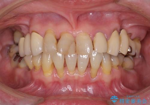 歯ぎしり・食いしばりから歯を守る高性能ナイトガードの症例 治療前