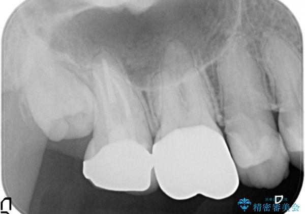 歯髄壊死と根尖性歯周炎を生じた右上7番への精密根管治療(イニシャルトリートメント)