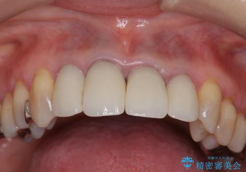 [emax セラミッククラウン] リーズナブルな前歯部審美セラミック治療の治療後