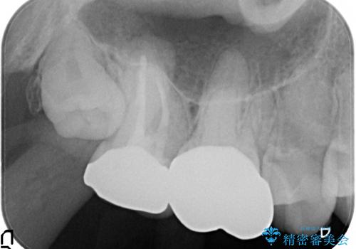 歯髄壊死を生じた右上7番への精密根管治療(イニシャルトリートメント)の治療後