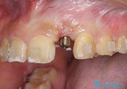 [骨造成を伴う前歯部審美インプラント治療①] インプラント埋入・骨造成・2次手術の治療後