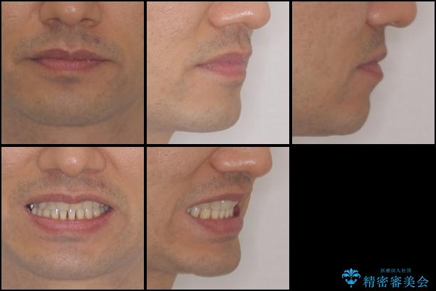 前歯の歯並びの改善　クリアブラケットによる矯正治療　の治療後（顔貌）