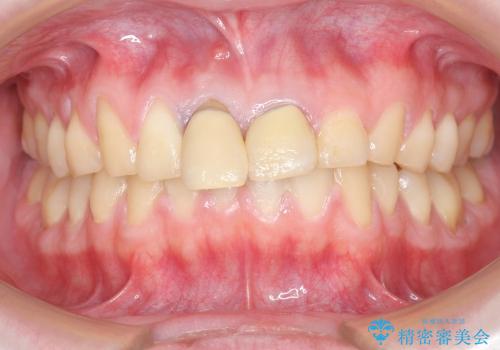 前歯のぐらつき　前歯部審美ブリッジ治療の治療前