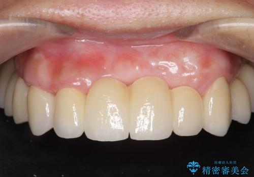[歯周病全顎治療] インプラントによる咬合機能回復と前歯審美改善