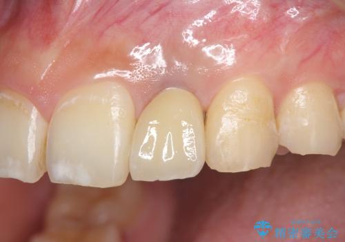 [骨造成を伴う前歯部審美インプラント治療②] ジルコニアカスタムアバットメント・クラウンの作製の治療後