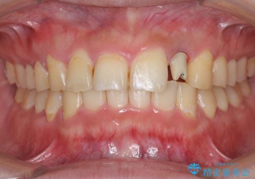 [骨造成を伴う前歯部審美インプラント治療②] ジルコニアカスタムアバットメント・クラウンの作製の治療中