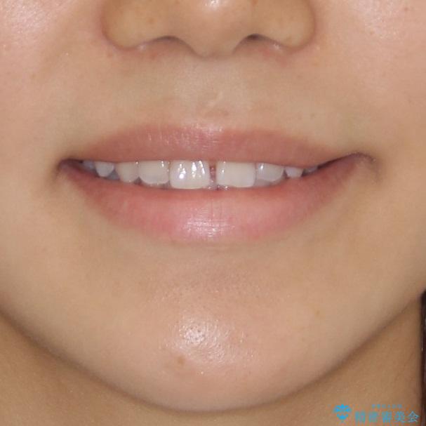 インビザラインとホワイトニング　白い歯ときれいな歯並びの治療前（顔貌）