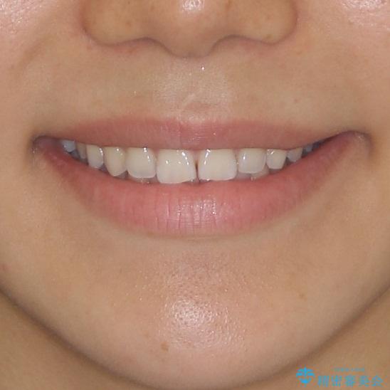 インビザラインとホワイトニング　白い歯ときれいな歯並びの治療後（顔貌）