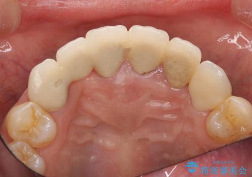 歯ぐきの腫脹も改善、セラミッククラウンのやりかえ治療の治療後