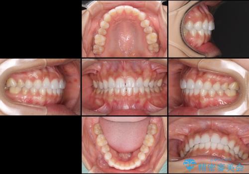 インビザラインとホワイトニング　白い歯ときれいな歯並びの治療後