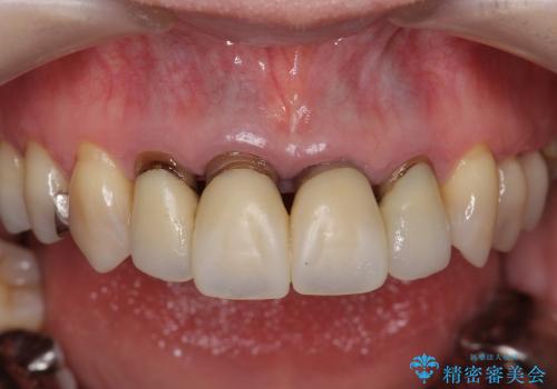 [emax セラミッククラウン] リーズナブルな前歯部審美セラミック治療の治療前