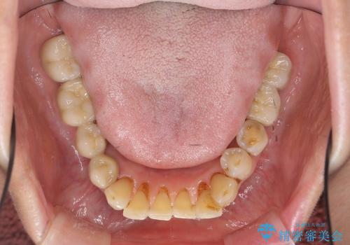 歯ぎしり・食いしばりから歯を守る高性能ナイトガードの治療中