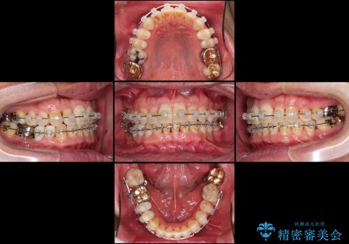 前歯の歯並びの改善　クリアブラケットによる矯正治療　の治療中