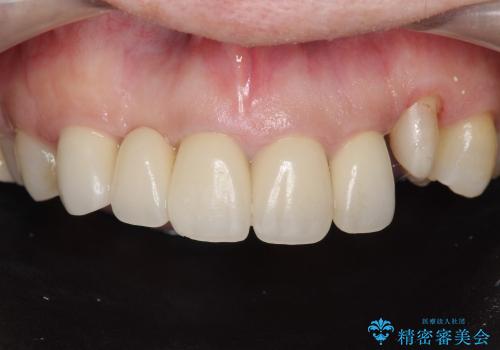 歯ぐきの腫脹も改善、セラミッククラウンのやりかえ治療の治療中