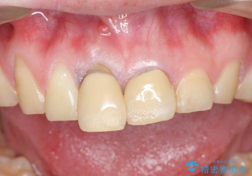 前歯のぐらつき　前歯部審美ブリッジ治療の治療前