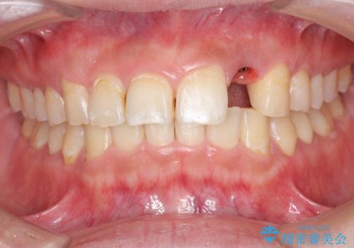 [骨造成を伴う前歯部審美インプラント治療②] ジルコニアカスタムアバットメント・クラウンの作製の治療前