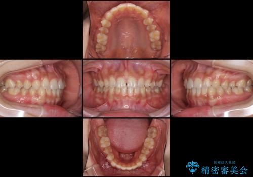 インビザラインとホワイトニング　白い歯ときれいな歯並びの治療中