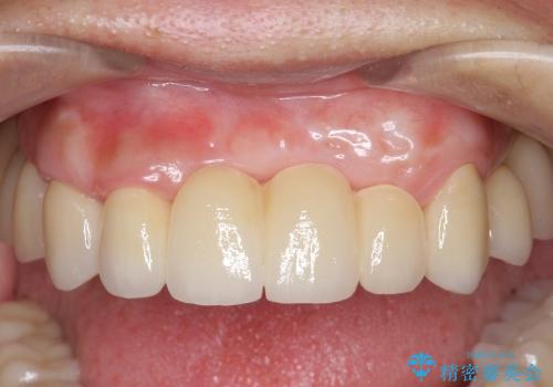 [歯周病全顎治療] インプラントによる咬合機能回復と前歯審美改善の治療後