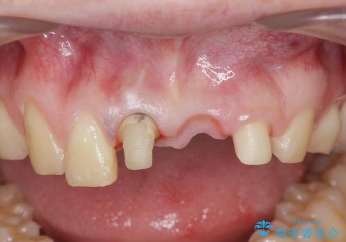 前歯のぐらつき　前歯部審美ブリッジ治療の治療中