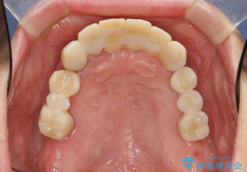 [歯周病全顎治療] インプラントによる咬合機能回復と前歯審美改善の治療中