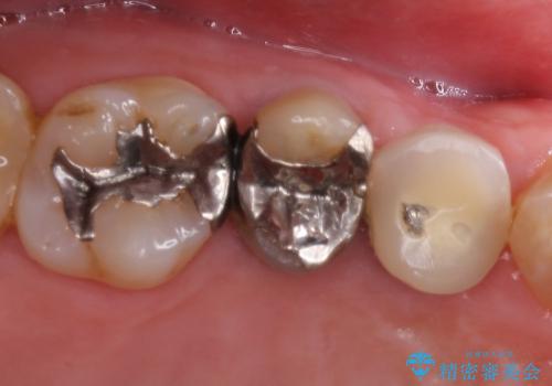 根管治療済みの歯の補綴の治療前