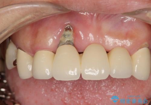 [歯周病全顎治療] インプラントによる咬合機能回復と前歯審美改善の治療前