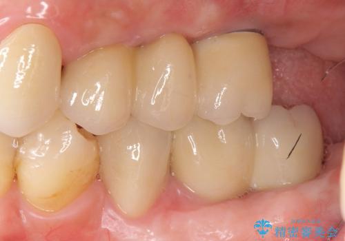 [歯周病全顎治療] インプラントによる咬合機能回復と前歯審美改善の治療後