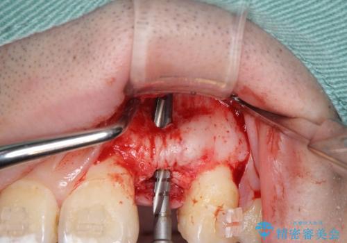 [骨造成を伴う前歯部審美インプラント治療①] インプラント埋入・骨造成・2次手術の治療中