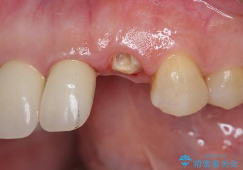 歯ぐきの腫脹も改善、セラミッククラウンのやりかえ治療の治療前