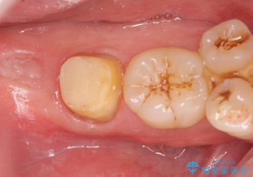親知らず放置が原因の深い虫歯の治療中