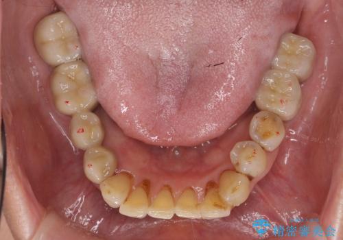歯ぎしり・食いしばりから歯を守る高性能ナイトガードの治療後