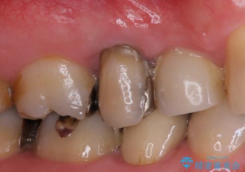 根管治療済みの歯の補綴の治療前