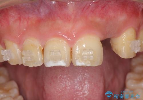 [骨造成を伴う前歯部審美インプラント治療①] インプラント埋入・骨造成・2次手術の治療後