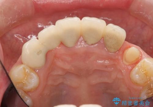 歯ぐきの腫脹も改善、セラミッククラウンのやりかえ治療の治療中