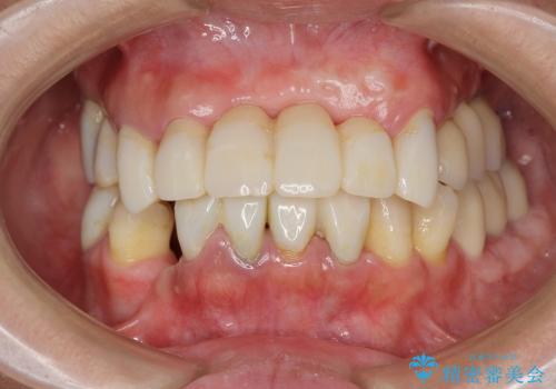 [歯周病全顎治療] インプラントによる咬合機能回復と前歯審美改善の治療中
