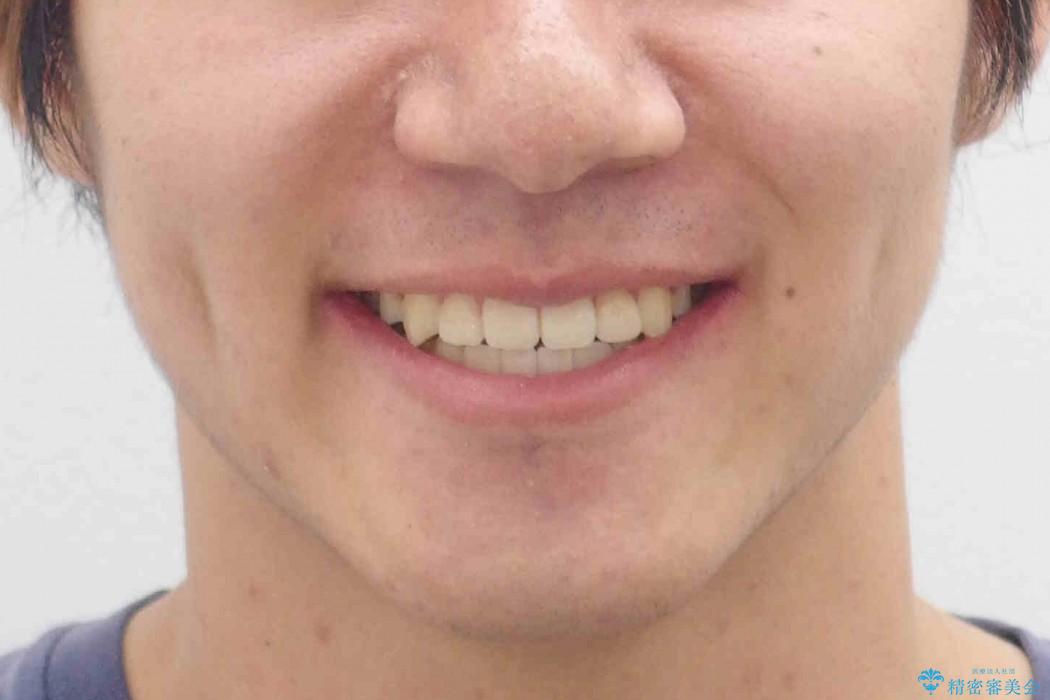 10代男子　八重歯　セカンドオピニオンの治療後（顔貌）