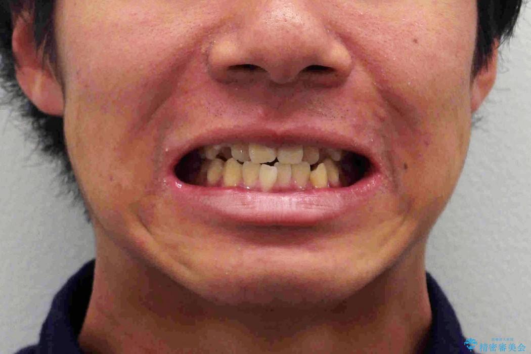 10代男子　八重歯　セカンドオピニオンの治療前（顔貌）