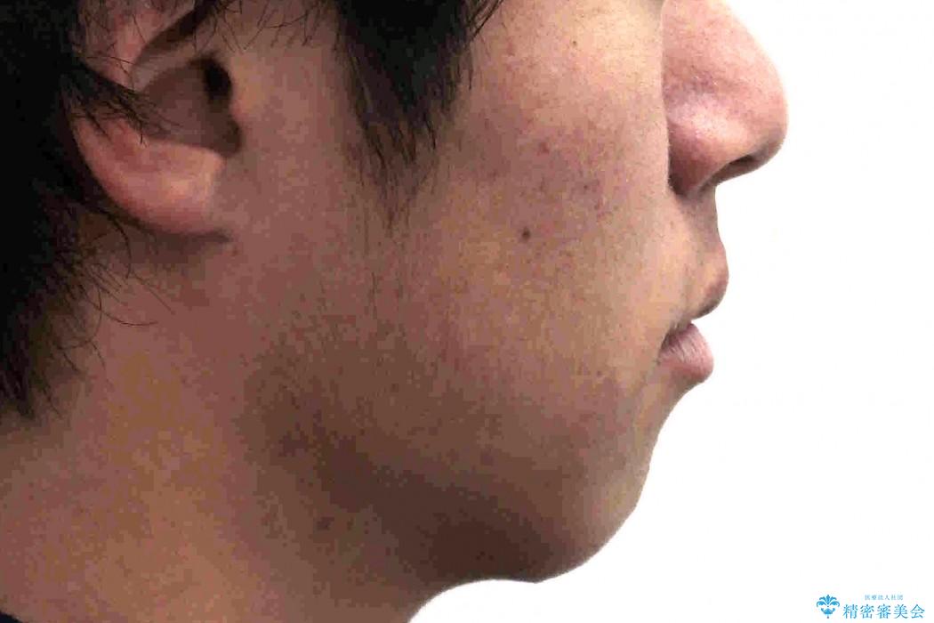 10代男子　八重歯　セカンドオピニオンの治療前（顔貌）
